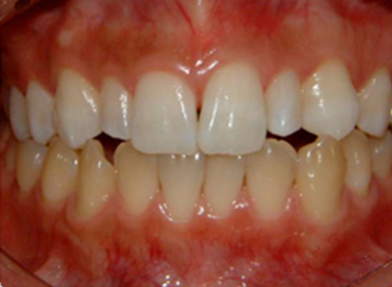 術中（上のみホワイトニングを行った状態）