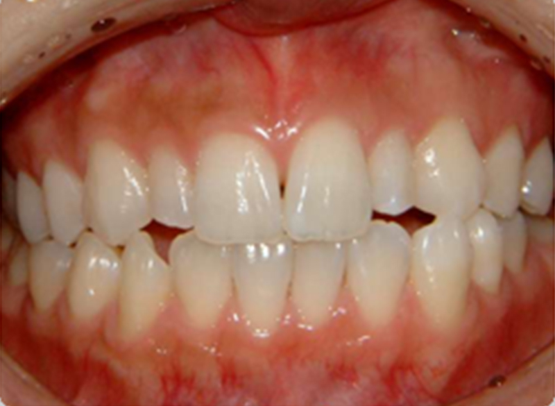 術後（上、下ホワイトニングが終了した状態）